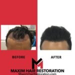 MAXiM Hair Restoration New York FUE FUT Transplant Surgeon Physician