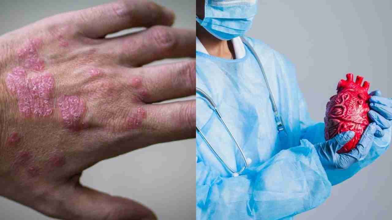 Psoriasis and Heart Disease: Expert Explains How This Skin Condition Increases Cardiac Issues