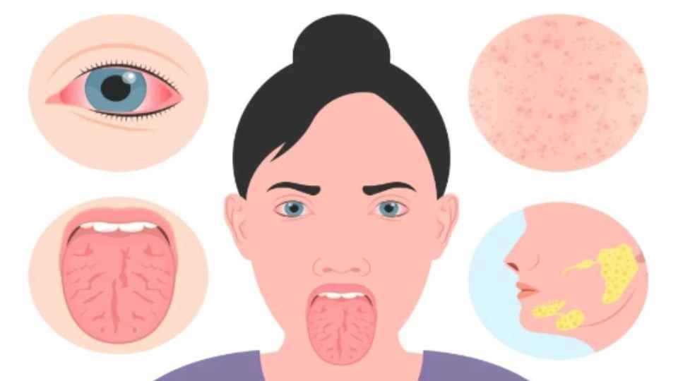 Understanding Sjögren’s Syndrome: Causes, Symptoms, and Treatment