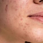 Demystifying Stubborn Acne: Understanding Causes, Treatment, and Prevention Strategies