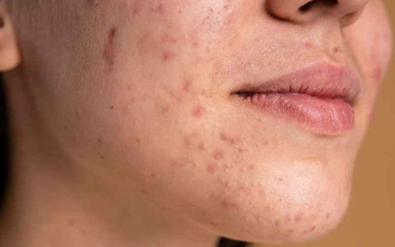 Demystifying Stubborn Acne: Understanding Causes, Treatment, and Prevention Strategies