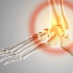 Brittle Bone Disease: Types, Causes, Symptoms, and Treatments