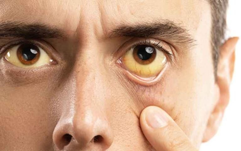 Yellow Fever: A Comprehensive Guide