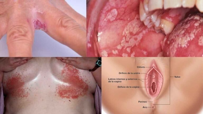 Candidiasis: Causes, Symptoms, Treatment, and Prevention