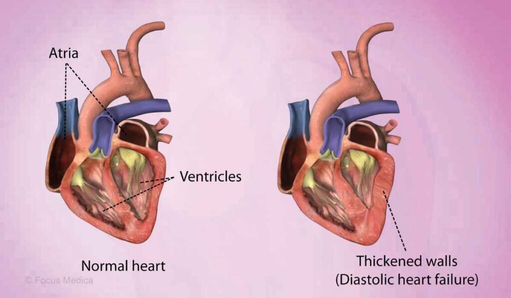 4 Stages of Congestive Heart Failure Explained Clearly