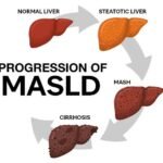 New Guidelines for MASLD: Diet, Exercise & Treatment