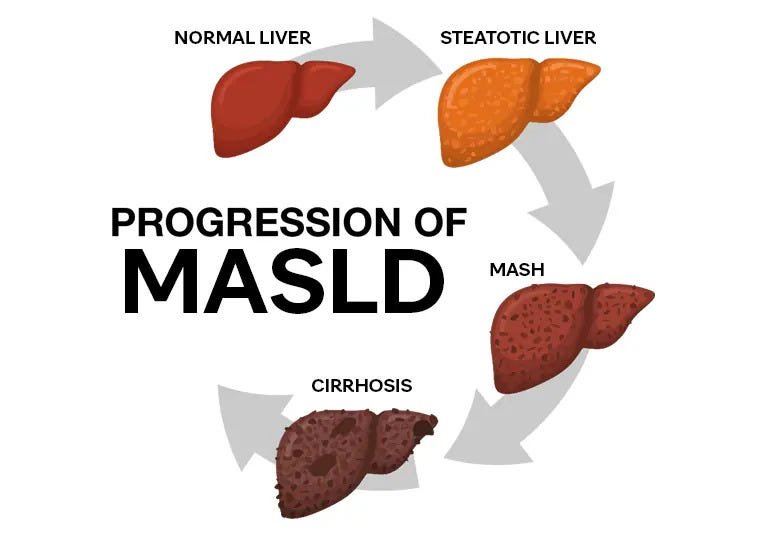 New Guidelines for MASLD: Diet, Exercise & Treatment